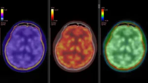 Japanese Scientists Uncover Key Mechanism Behind Ketamine’s Rapid Antidepressant Effects Through Advanced Brain Imaging
