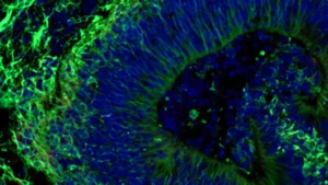 Johns Hopkins Researchers Uncover Promising New Avenues for Alzheimer’s Treatment Personalization Through Brain Organoid Studies