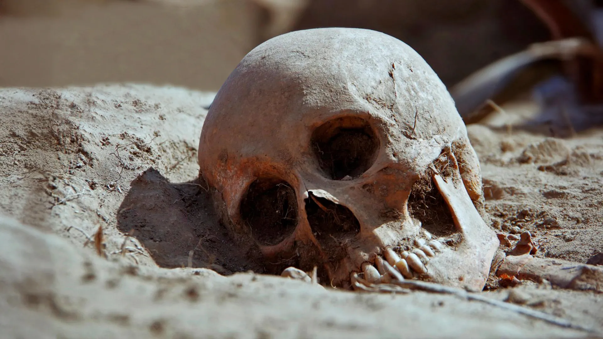 Rewriting Medical History: New Evidence Challenges Traditional Understanding of Congenital Syphilis and Ancient Pathogens